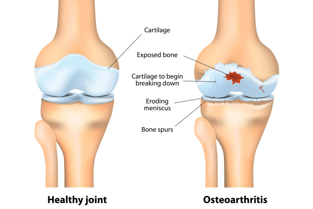 https://diseaseandmedicationawareness.com/osteoarthritis-icd-10-guide-for-doctors-and-patients/
