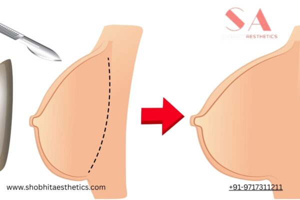Breast Augmentation Surgery
