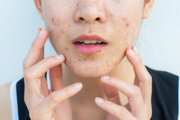 Close-up of a woman with acne on her face before Acne Treatment Chevy Chase.