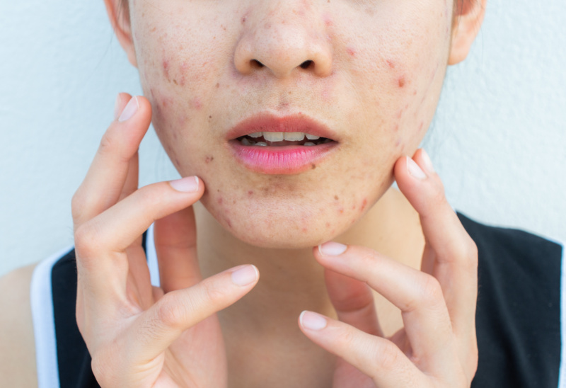 Close-up of a woman with acne on her face before Acne Treatment Chevy Chase.