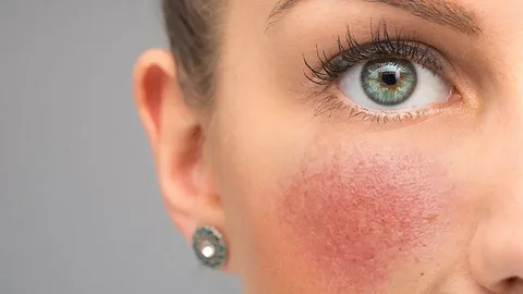 how to reduce redness on face quickly